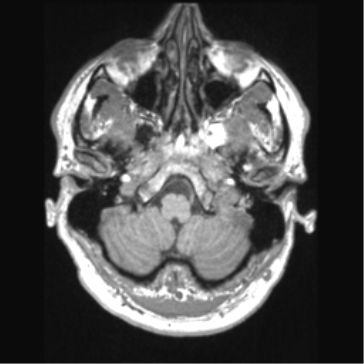 Cerebral arteriovenous malformation (Radiopaedia 39259-41506 Axial T1 14).png
