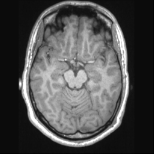 Cerebral arteriovenous malformation (Radiopaedia 39259-41506 Axial T1 31).png