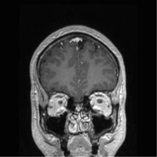 Cerebral arteriovenous malformation (Radiopaedia 39259-41506 Coronal T1 C+ 75).png