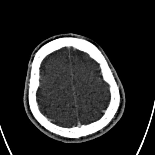 Cerebral arteriovenous malformation (Radiopaedia 78188-90746 Axial C+ delayed 146).jpg