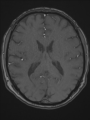 Cerebral arteriovenous malformation (Radiopaedia 84015-99245 Axial TOF 142).jpg