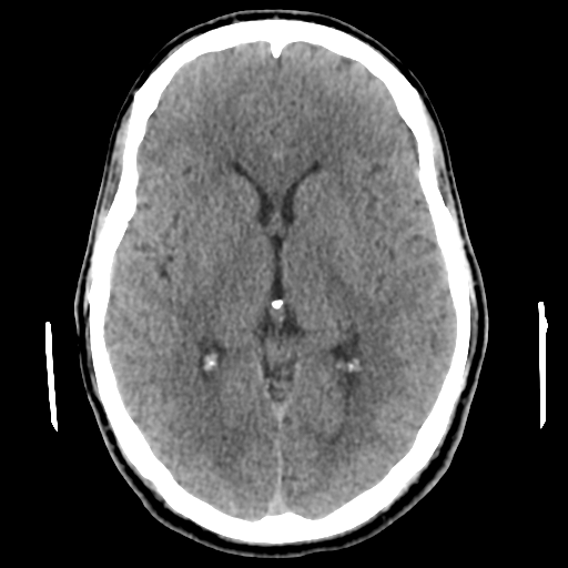 Cerebral arteriovenous malformation (Spetzler-Martin grade 2) (Radiopaedia 41262-44076 Axial non-contrast 28).png