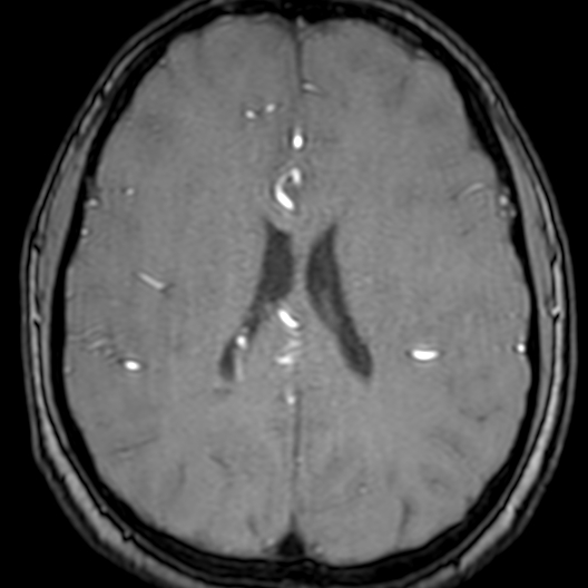 Cerebral arteriovenous malformation at posterior body of corpus callosum (Radiopaedia 74111-84925 Axial MRA 137).jpg