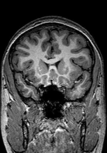 Cerebral arteriovenous malformation at posterior body of corpus callosum (Radiopaedia 74111-84925 Coronal T1 102).jpg