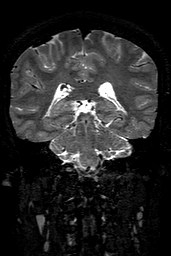 Cerebral arteriovenous malformation at posterior body of corpus callosum (Radiopaedia 74111-84925 Coronal T2 112).jpg