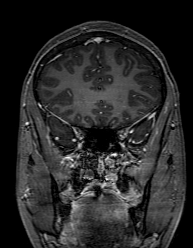 Cerebral arteriovenous malformation at posterior body of corpus callosum (Radiopaedia 74111-84925 K 98).jpg