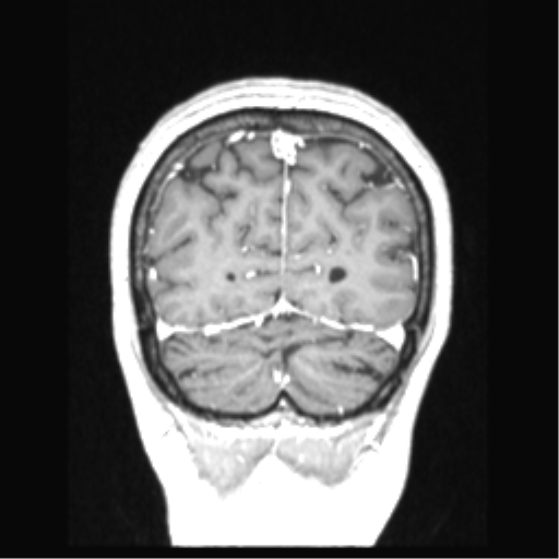 Cerebral arteriovenous malformation with hemorrhage (Radiopaedia 34422-35737 Coronal T1 C+ 19).png