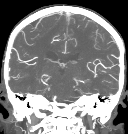 Cerebral arteriovenous malformation with lobar hemorrhage (Radiopaedia 44725-48511 B 34).png
