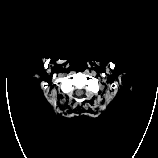 File:Cerebral arteriovenous malformation with lobar hemorrhage (Radiopaedia 44725-48512 Axial non-contrast 6).png