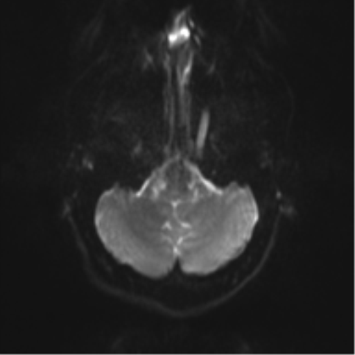 File:Cerebral cavernoma and development venous anomaly (Radiopaedia 37603-39482 Axial DWI 5).png