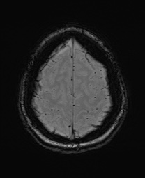 File:Cerebral cavernous venous malformation (Radiopaedia 70008-80021 I 63).jpg