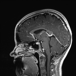 Cerebral cavernous venous malformation (Radiopaedia 70008-80021 Sagittal T1 C+ 35).jpg