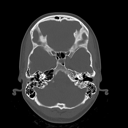 Cerebral cavernous venous malformation (Radiopaedia 70008-80022 Axial bone window 9).jpg