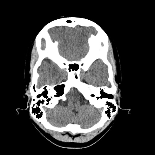 Cerebral cavernous venous malformation (Radiopaedia 70008-80022 Axial non-contrast 9).jpg