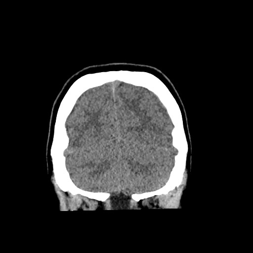 Cerebral cavernous venous malformation (Radiopaedia 70008-80022 non-contrast 59).jpg