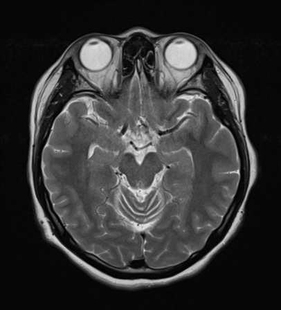 File:Cerebral cavernous venous malformations (Radiopaedia 48117-52946 Axial T2 10).png