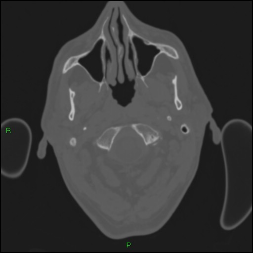 Cerebral contusions (Radiopaedia 33868-35039 Axial bone window 3).jpg