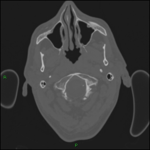 File:Cerebral contusions (Radiopaedia 33868-35039 Axial bone window 7).jpg