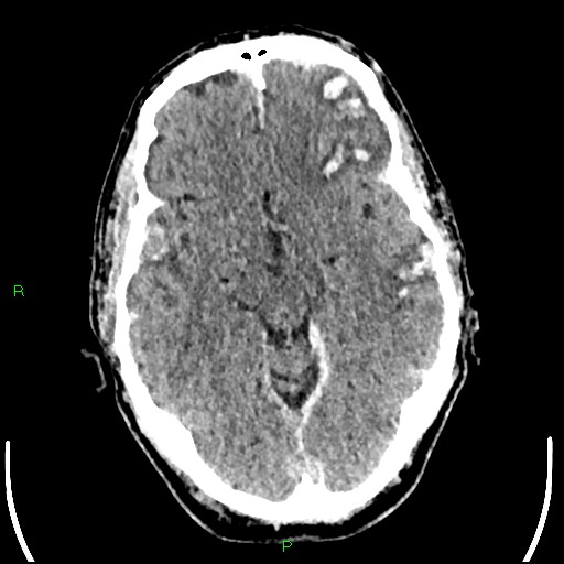 Cerebral contusions (Radiopaedia 33868-35039 Axial non-contrast 85).jpg