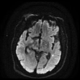 Cerebral embolic infarcts (embolic shower) (Radiopaedia 49837-55108 Axial DWI 75).jpg
