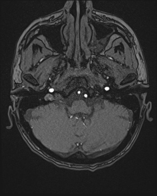 Cerebral embolic infarcts (embolic shower) (Radiopaedia 72391-82921 Axial MRA 11).jpg
