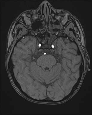 Cerebral embolic infarcts (embolic shower) (Radiopaedia 72391-82921 Axial MRA 41).jpg