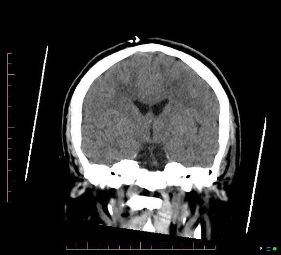 Cerebral fat embolism (Radiopaedia 85521-101220 Coronal non-contrast 32).jpg