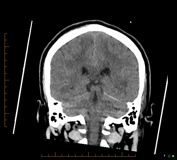 Cerebral fat embolism (Radiopaedia 85521-101220 Coronal non-contrast 41).jpg