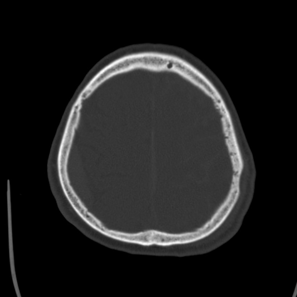 Cerebral hemorrhagic contusions (Radiopaedia 23145-23188 Axial bone window 47).jpg