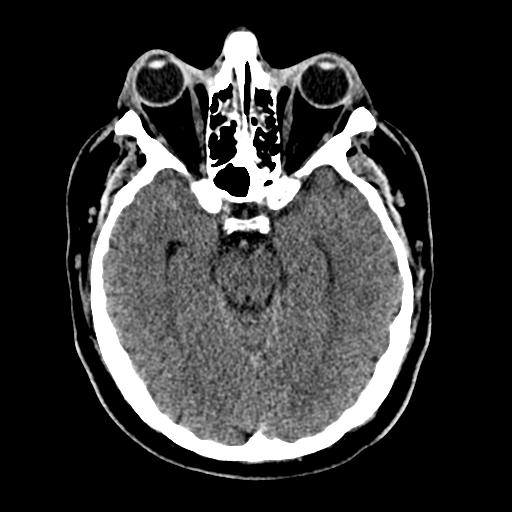 File:Cerebral hemorrhagic contusions and cervical spine fractures (Radiopaedia 32865-33841 Axial non-contrast 14).jpg