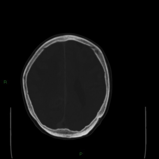 File:Cerebral metastases - breast primary (Radiopaedia 77653-89857 Axial bone window 78).jpg