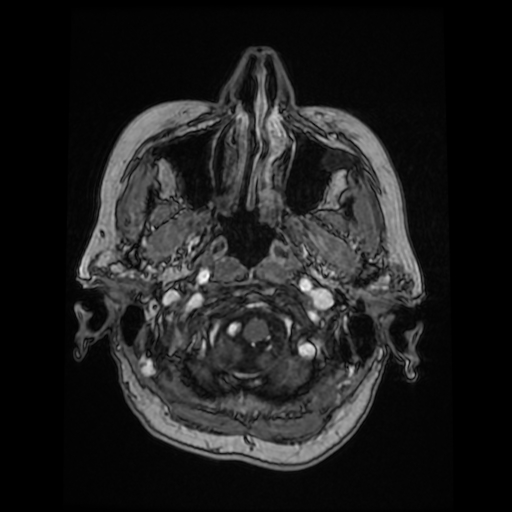 Cerebral metastases - melanoma (Radiopaedia 80972-94522 Axial T1 C+ 25).jpg
