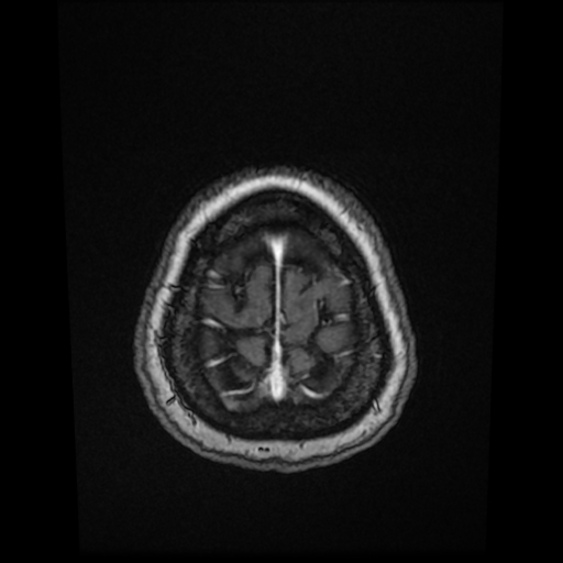Cerebral metastases - melanoma (Radiopaedia 80972-94522 Axial T1 C+ 84).jpg