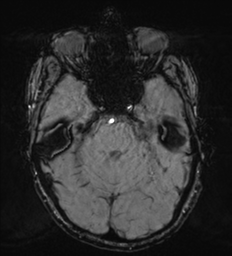 Cerebral metastasis - melanoma (Radiopaedia 54718-60954 Axial SWI 17).png