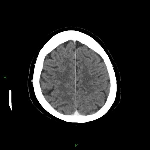 File:Cerebral metastasis from renal cell carcinoma (Radiopaedia 82306-96375 Axial C+ delayed 31).jpg