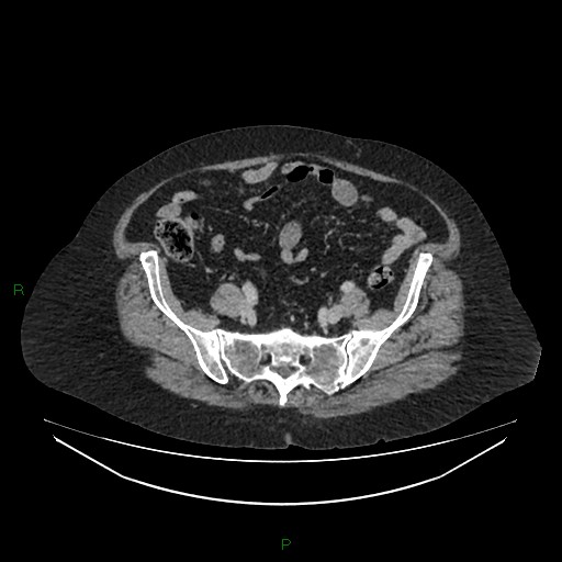 Cerebral metastasis from renal cell carcinoma (Radiopaedia 82306-96378 A 140).jpg