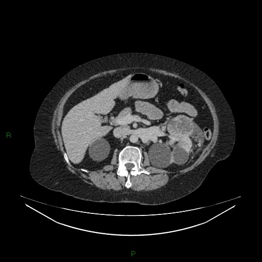 Cerebral metastasis from renal cell carcinoma (Radiopaedia 82306-96378 A 65).jpg