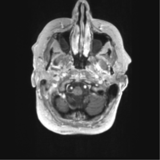 Cerebral metastasis mimicking glioblastoma (Radiopaedia 69155-78937 Axial T1 C+ 1).png