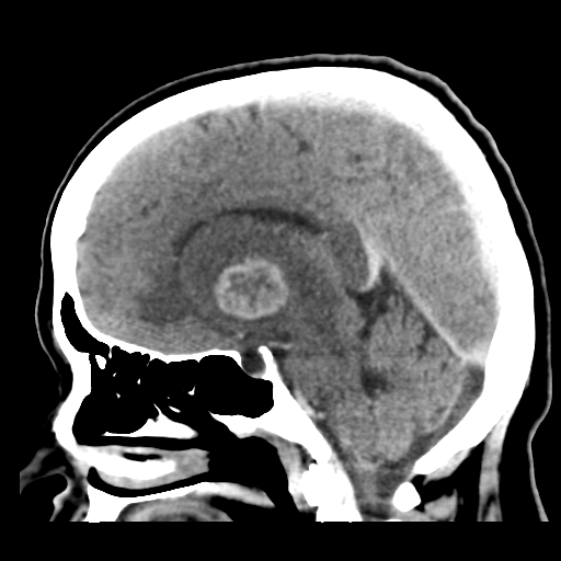 Cerebral metastasis to basal ganglia (Radiopaedia 81568-95412 Sagittal C+ delayed 28).png