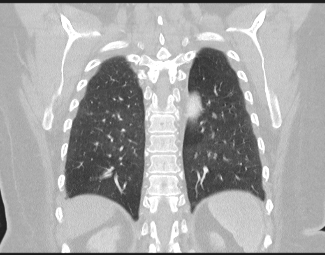 File:Cerebral metastasis to basal ganglia (Radiopaedia 81568-95414 Coronal lung window 66).png