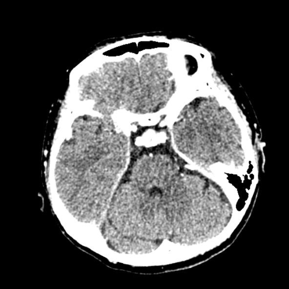 File:Cerebral ring enhancing lesions - cerebral metastases (Radiopaedia 44922-48818 B 97).jpg
