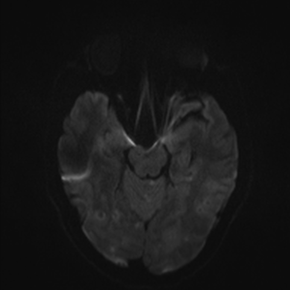 File:Cerebral toxoplasmosis (Radiopaedia 53993-60132 Axial DWI 37).jpg
