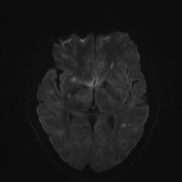 Cerebral toxoplasmosis (Radiopaedia 53993-60132 Axial DWI 40).jpg