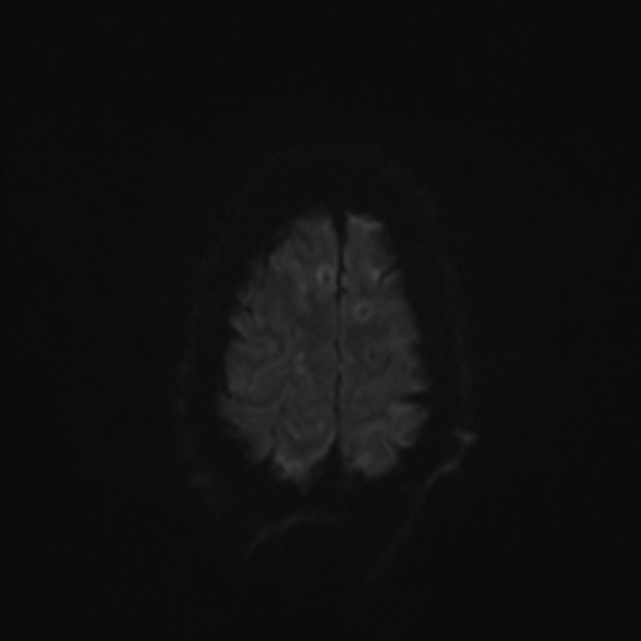 Cerebral toxoplasmosis (Radiopaedia 53993-60132 Axial DWI 51).jpg