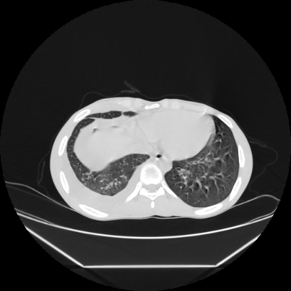 Cerebral tuberculoma (Radiopaedia 80829-94318 Axial lung window 142).jpg