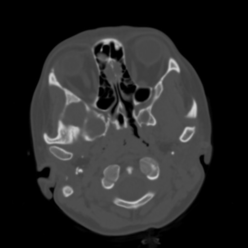 Cerebral tuberculosis with dural sinus invasion (Radiopaedia 60353-68018 Axial bone window 3).jpg
