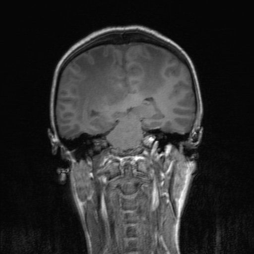 Cerebral tuberculosis with dural sinus invasion (Radiopaedia 60353-68090 Coronal T1 112).jpg