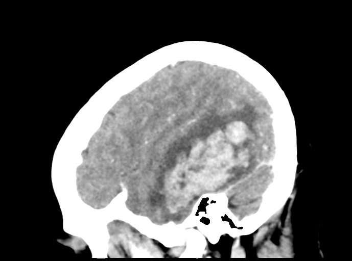 Cerebral venous hemorrhagic infarction (Radiopaedia 57576-64538 Sagittal C+ 12).png