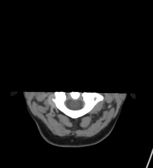 File:Cerebral venous infarction due to transverse sinus thrombosis (Radiopaedia 34688-36120 Axial CT venogram 2).png
