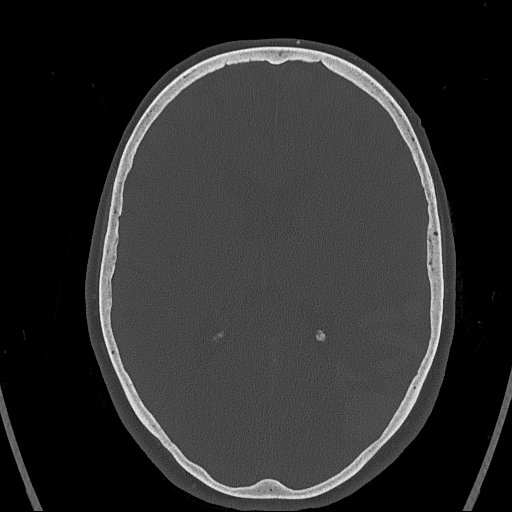 Cerebral venous infarction with hemorrhage (Radiopaedia 65343-74381 Axial bone window 100).jpg